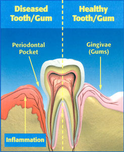 arestin-gun-disease-diagram