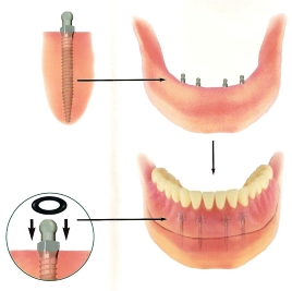 Marietta Dentures Dentist