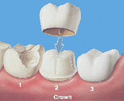 graphic of dental crown