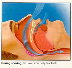 picture of during snoring