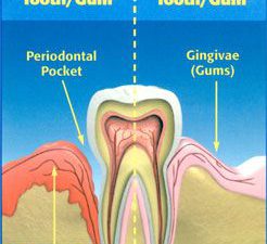 arestin gun disease diagram