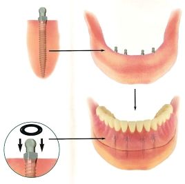 location of the artificial jaw