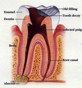 picture of tooth root canal