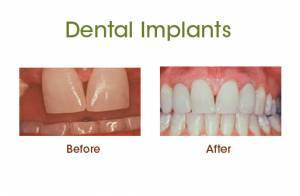 Dental Implants before and after