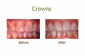 crowns before and after