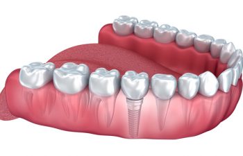 Implant Model Atlanta GA