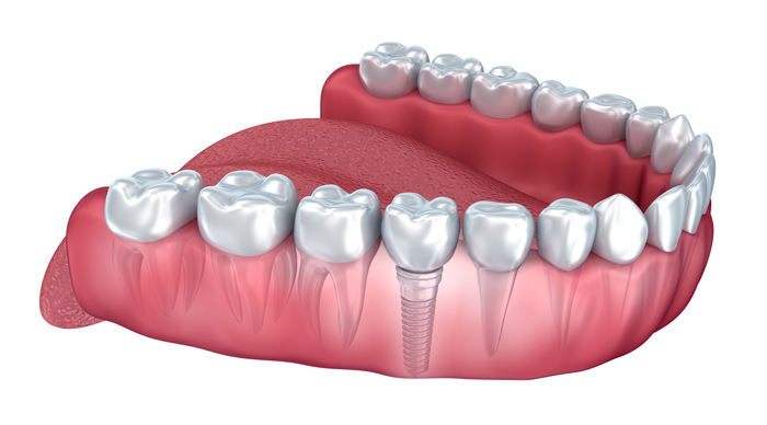 Implant Model